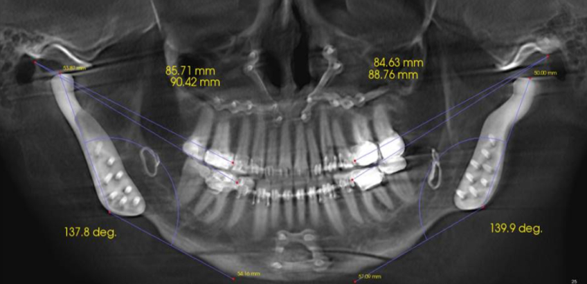 This patient was treated with a total joint replacement, maxillary impaction, mandibular advancement, and a genioplasty.
