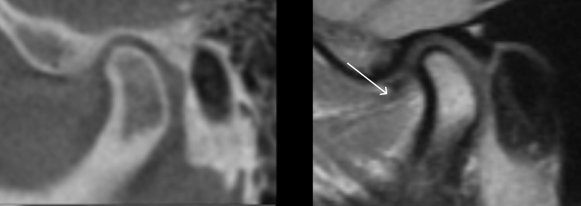 The CBCT at left shows the condyle concentrically located in the fossa. The arrow in the image at right shows the anteriorly displaced disk with the condyle concentrically located in the fossa, supported by the retrodiscal tissue.  