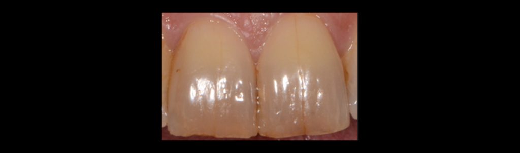 Craze lines on an anterior tooth showing superficial enamel cracks with no dentin involvement.