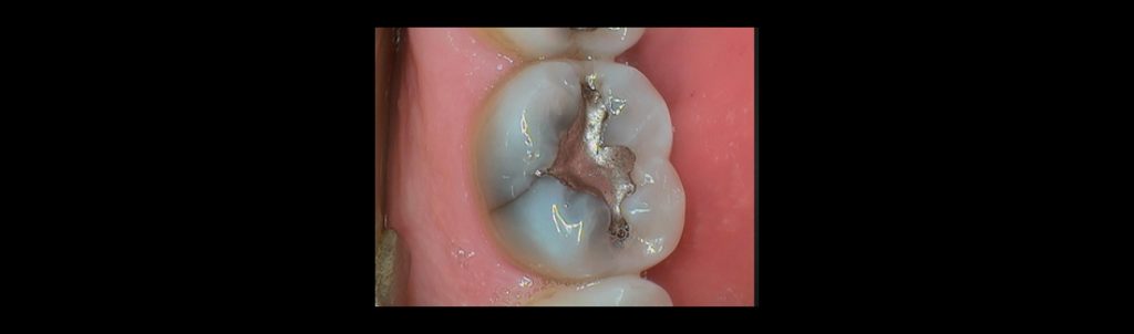 Dental photo of a restored tooth that has cracked.