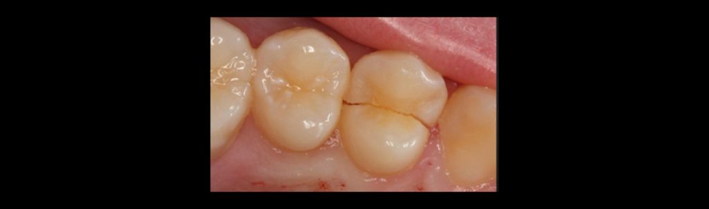 Split tooth extending across the crown, showing a severe tooth crack that may require extraction