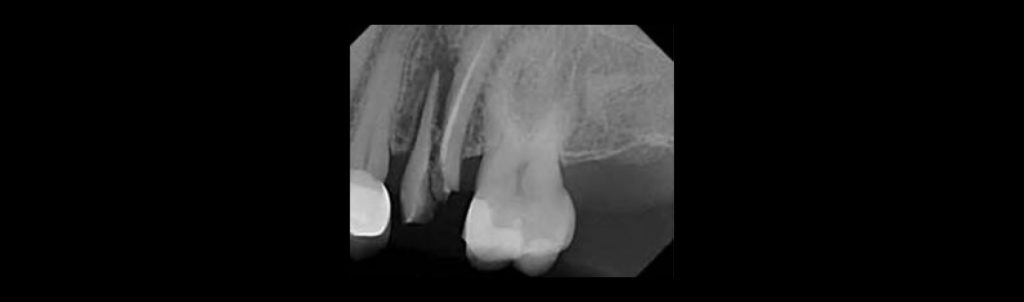 Dental radiograph of a vertical root fracture associated with a severe tooth crack affecting the root
