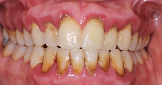 Definitive Guide to Diagnosing Periodontitis Today Diagnosing periodontitis with visible gingival recession and clinical attachment loss on anterior teeth