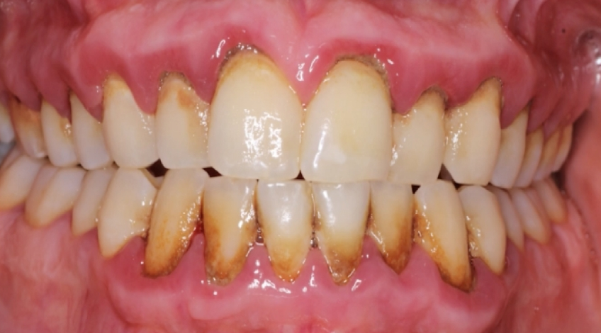 Severe periodontal disease example used in diagnosing periodontitis for treatment planning decisions