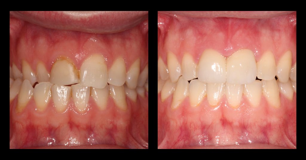 Before and after results of orthodontic-restorative treatment planning showing improved tooth position, gingival symmetry, and esthetic restoration of the anterior teeth.