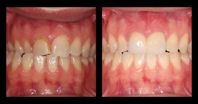 Before and after results of orthodontic-restorative treatment planning showing improved tooth position, gingival symmetry, and esthetic restoration of the anterior teeth.