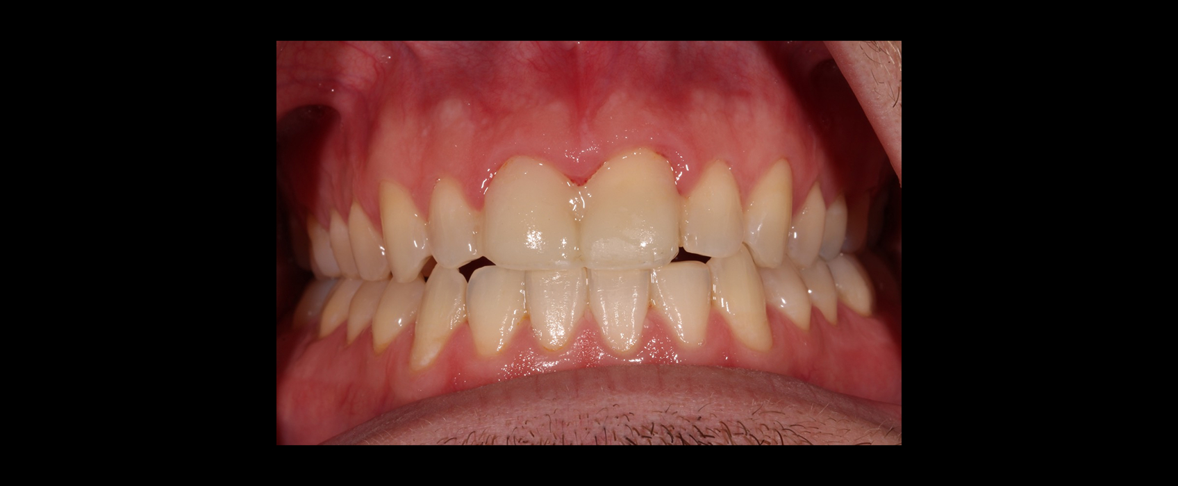 Diagnostic provisional restorations used to validate esthetics and occlusion during orthodontic restorative treatment planning.