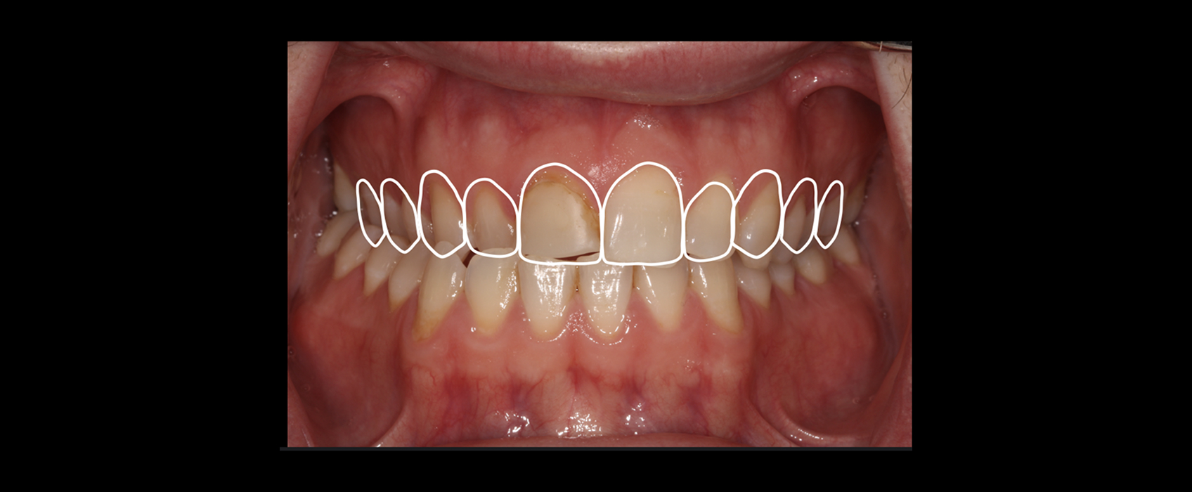 FGTP analysis outlining ideal tooth proportions used to guide orthodontic restorative treatment planning prior to orthodontics.
