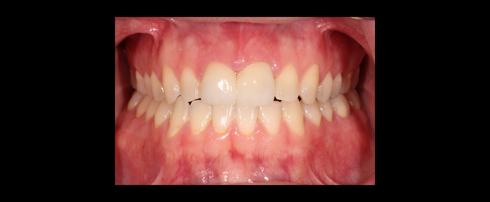 Final frontal retracted view after orthodontic restorative treatment planning and completion of porcelain restorations.