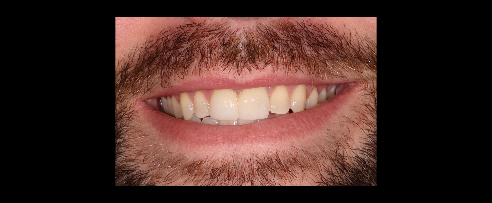 Final smile after orthodontic restorative treatment planning showing balanced esthetics and harmonious tooth proportions.