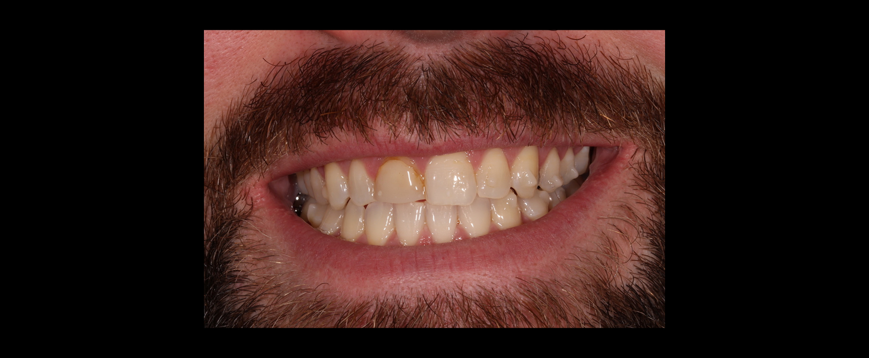 Post-orthodontic smile showing improved alignment supporting orthodontic restorative treatment planning.