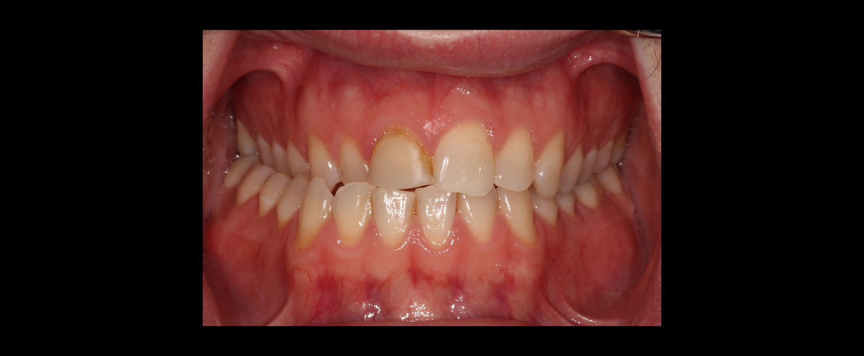 Frontal retracted intraoral view showing crossbite and gingival asymmetry assessed with orthodontic restorative treatment planning.