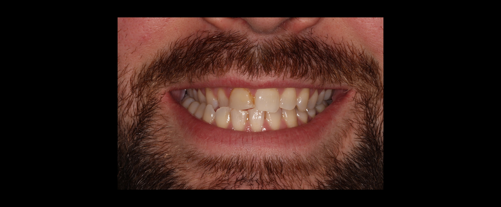 Pre-operative smile highlighting tooth position and esthetic imbalance addressed through orthodontic restorative treatment planning.