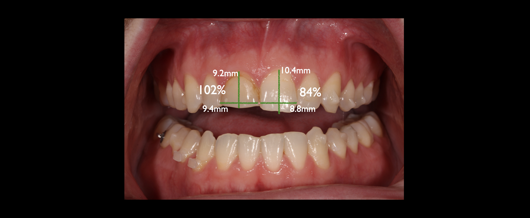 Tooth width and height measurements after orthodontics used to guide orthodontic restorative treatment planning.
