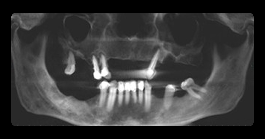 How to Plan Phased Restorative Dentistry for Complex Wear Digest Featured Phased Restorative Dentistry