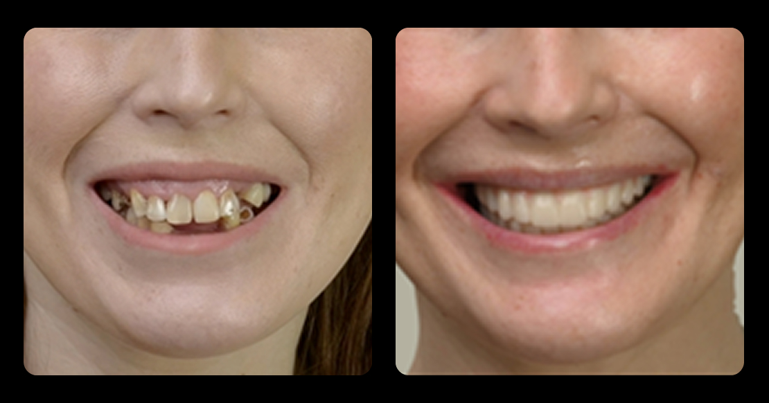 Before and after results of full arch rehabilitation with All-on-X dental implants showing smile transformation