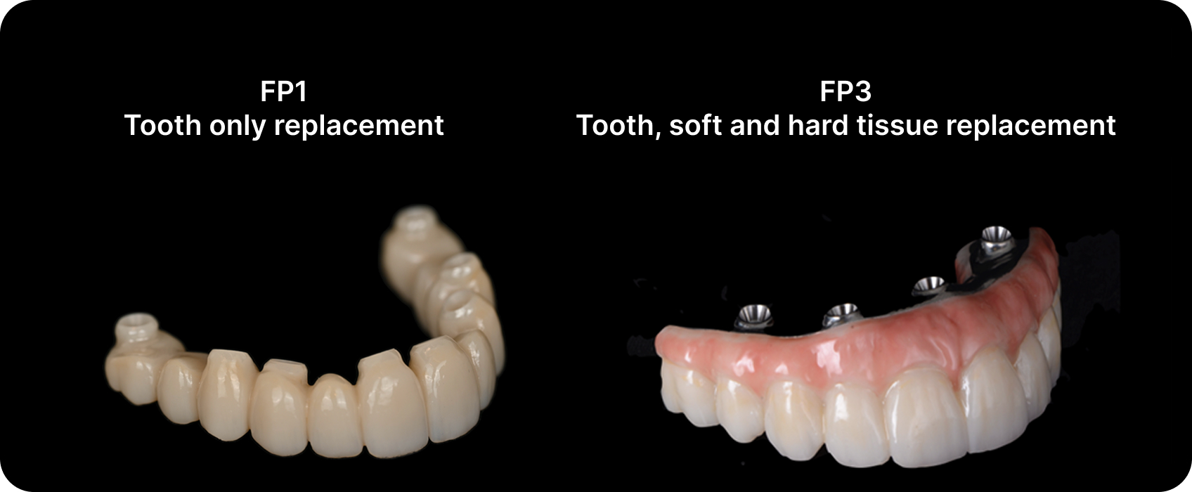 FP1 vs FP3 All-on-X dental implant prosthesis comparison  