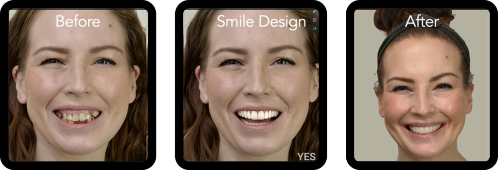 Before and after smile transformation with All-on-X dental implants and digital smile design