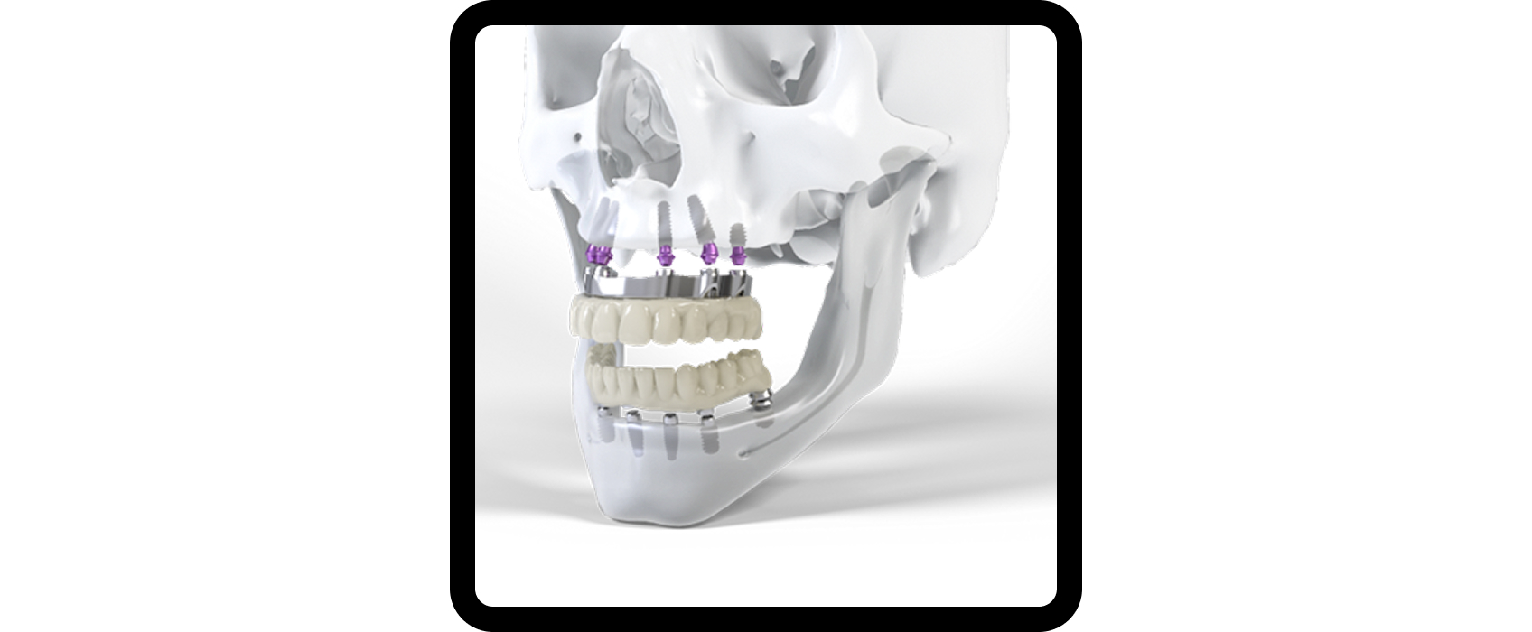 All-on-X dental implants, full arch Straumann Pro-Arch prosthesis example 