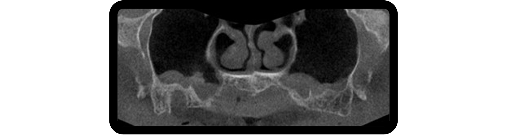 How to Plan Phased Restorative Dentistry for Complex Wear CBCT scan showing bilateral maxillary sinus radiolucencies identified during phased restorative dentistry surgical planning