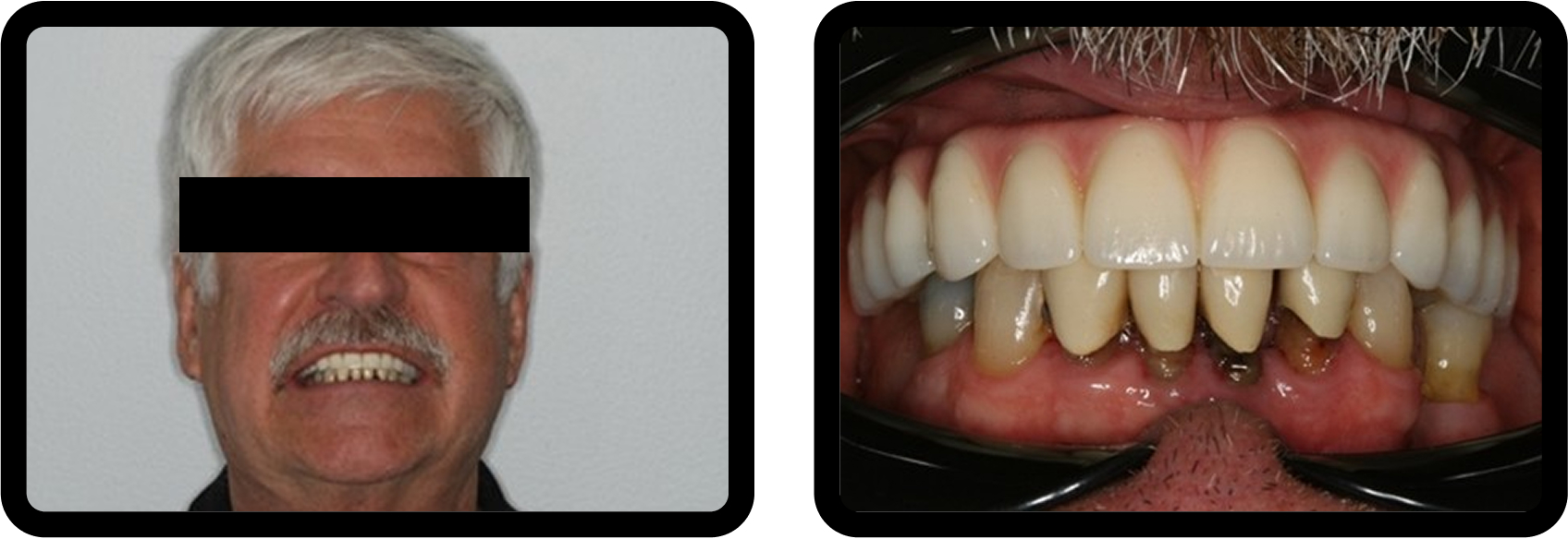 How to Plan Phased Restorative Dentistry for Complex Wear Postoperative intraoral and extraoral views showing completion of the maxillary arch during the definitive phase of phased restorative dentistry