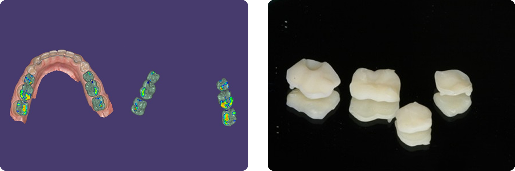 How to Plan Phased Restorative Dentistry for Complex Wear Digital intraoral scans, occlusal analysis, and fabricated posterior resin onlays used in phased restorative dentistry for diagnostic wax-up and conservative restoration planning