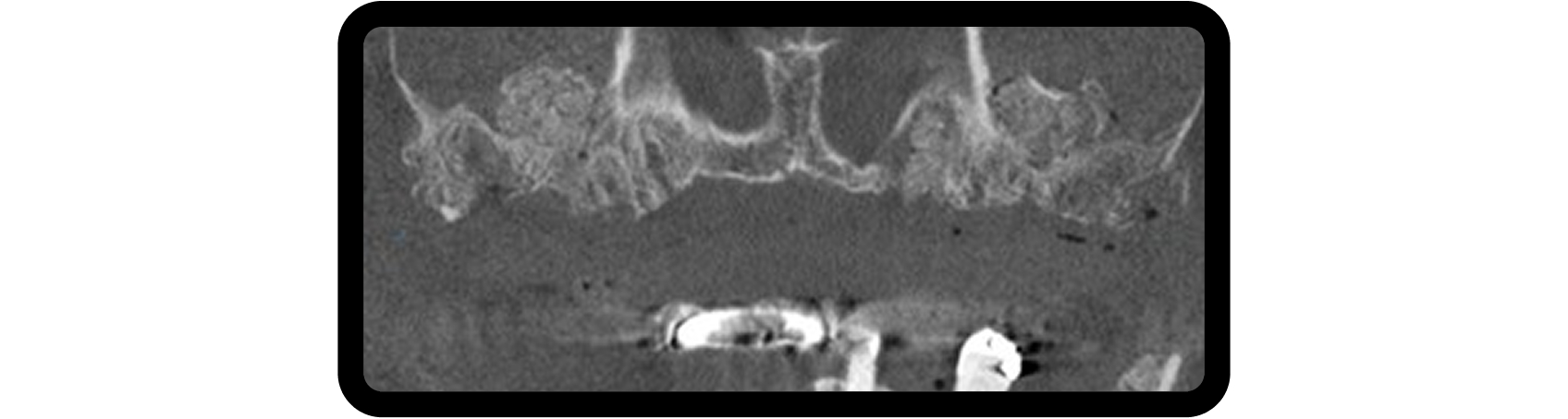 How to Plan Phased Restorative Dentistry for Complex Wear CBCT image showing lateral window sinus augmentation with graft material placed in areas of osseous deficiency during phased restorative dentistry