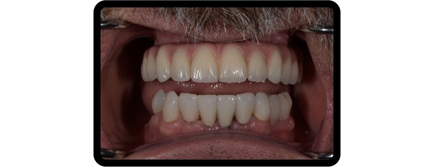 How to Plan Phased Restorative Dentistry for Complex Wear Mandibular arch provisionalized at increased vertical dimension during phased restorative dentistry to evaluate patient adaptation and function