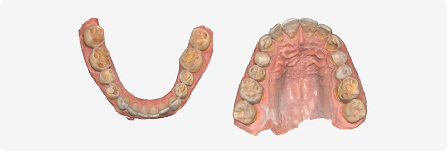 How to Plan Phased Restorative Dentistry for Complex Wear Digital maxillary and mandibular occlusal views showing severe generalized tooth wear in a 34-year-old patient evaluated for phased restorative dentistry