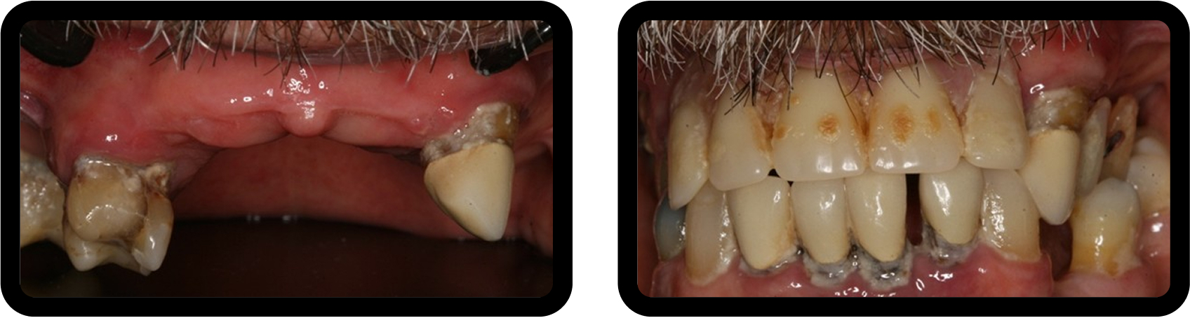 How to Plan Phased Restorative Dentistry for Complex Wear Intraoral views showing occlusal collapse with uneven wear and super-eruption in a phased restorative dentistry case involving vertical dimension loss