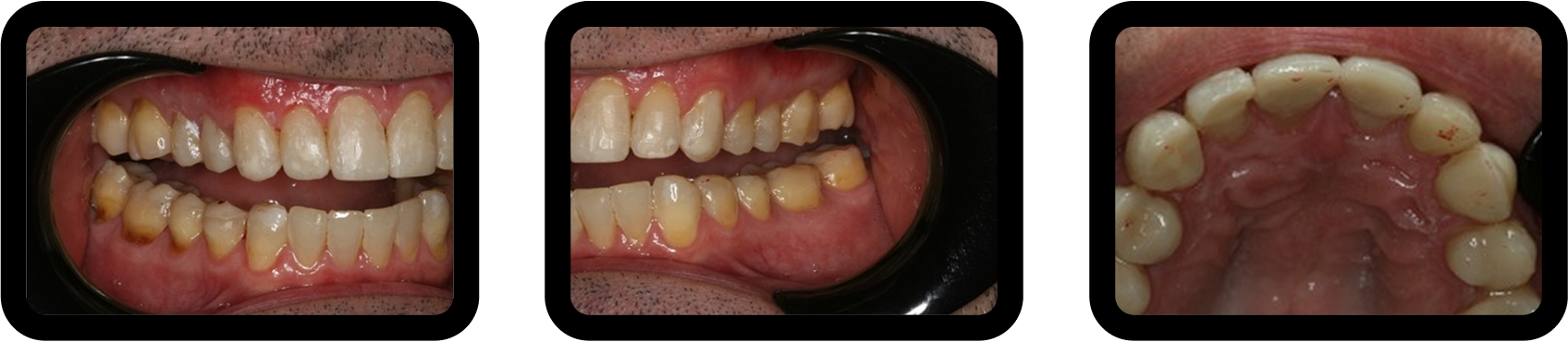How to Plan Phased Restorative Dentistry for Complex Wear Posterior occlusal equilibration and anterior direct composite restorations performed at increased vertical dimension during phased restorative dentistry treatment