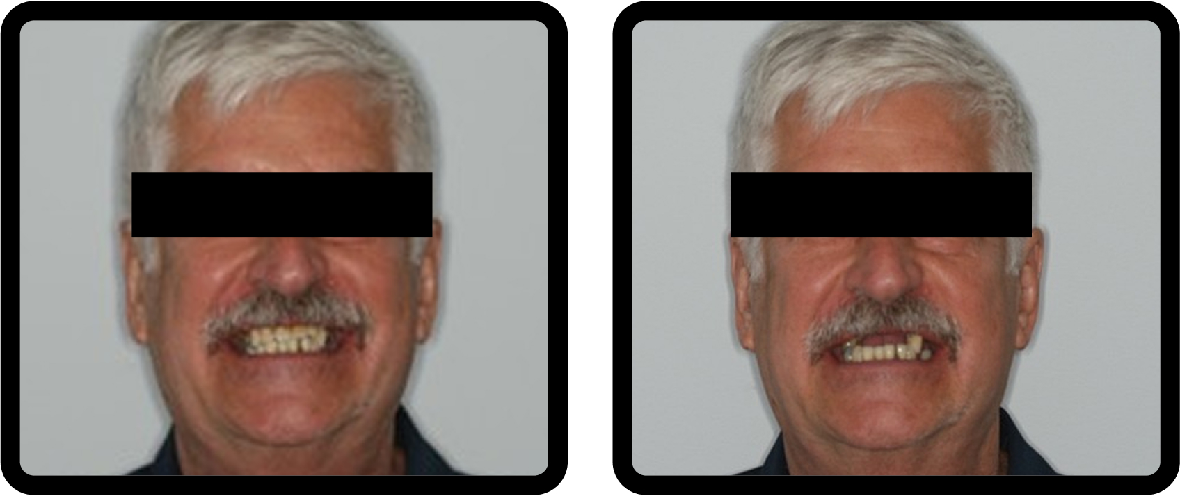 How to Plan Phased Restorative Dentistry for Complex Wear Preoperative showing failing maxillary dentition with a removable partial denture, occlusal collapse, and vertical dimension loss in a phased restorative dentistry case