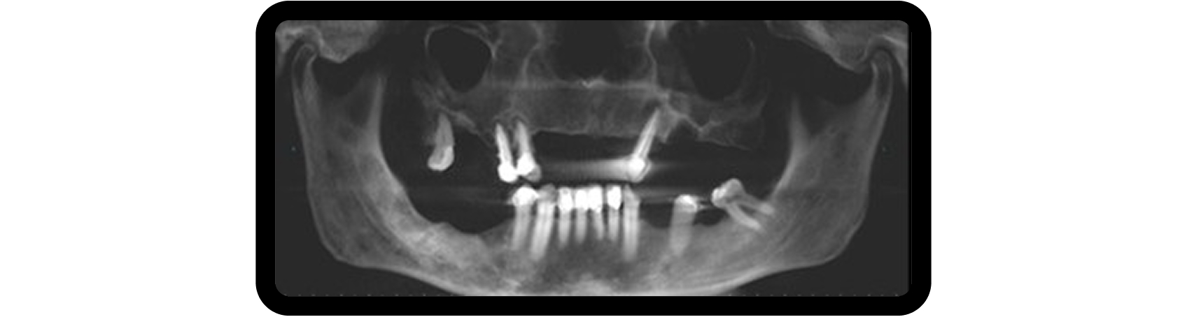 How to Plan Phased Restorative Dentistry for Complex Wear Panoramic radiograph used for radiographic evaluation during the foundation phase of phased restorative dentistry treatment planning