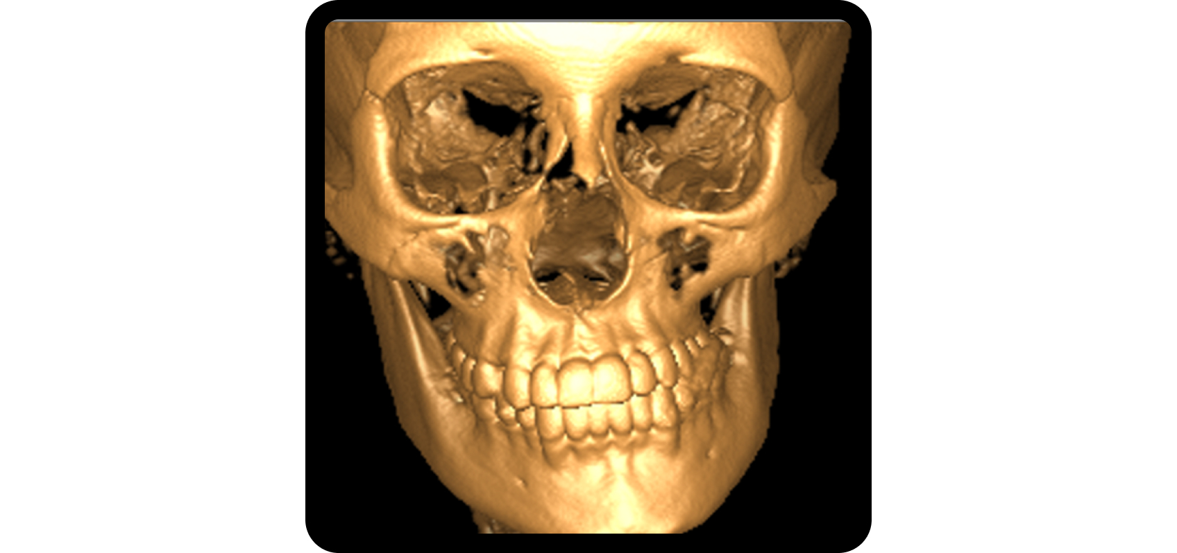 3D craniofacial imaging demonstrating asymmetry associated with TMJ disc displacement