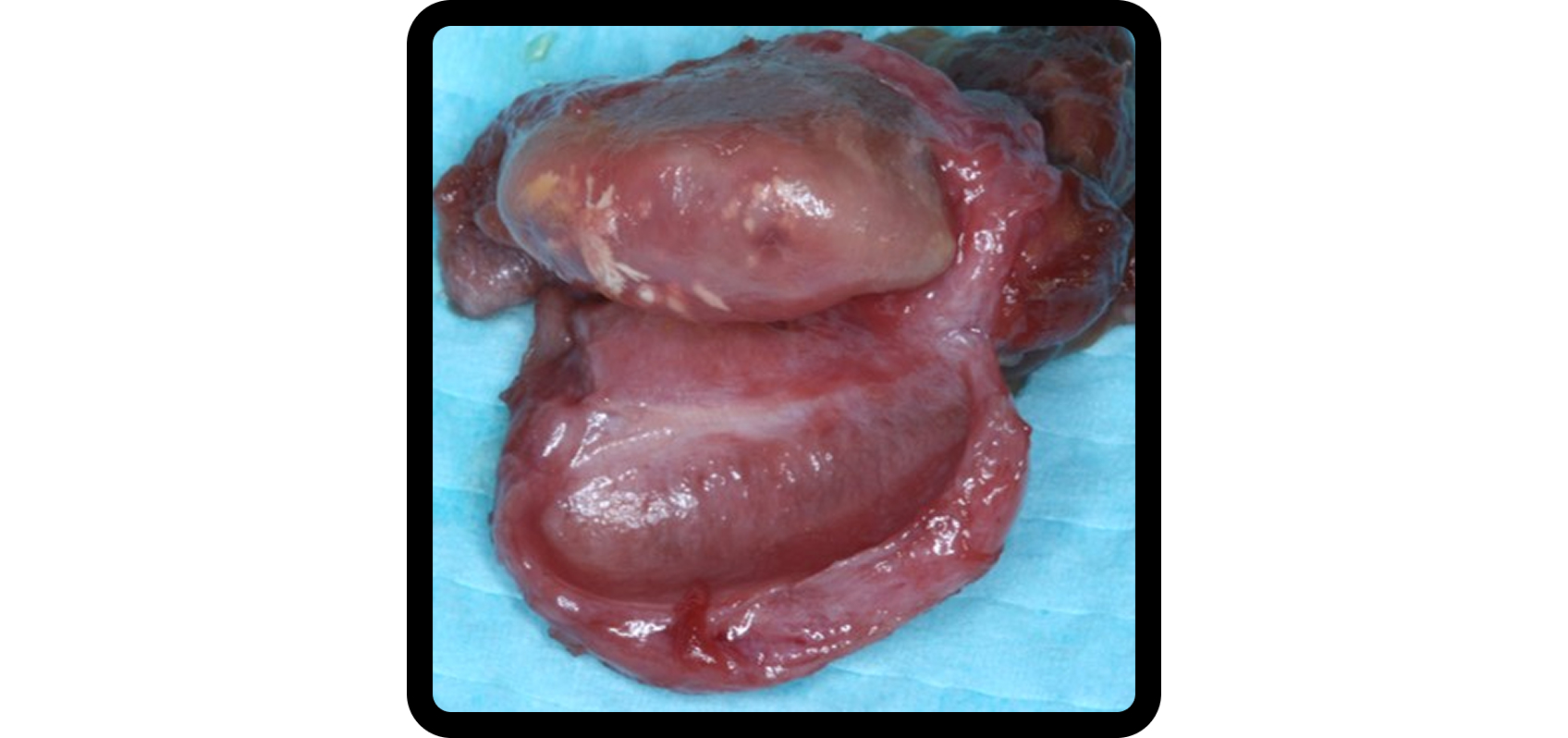 Surgical specimen showing TMJ disc and mandibular condylar cartilage relevant to craniofacial growth