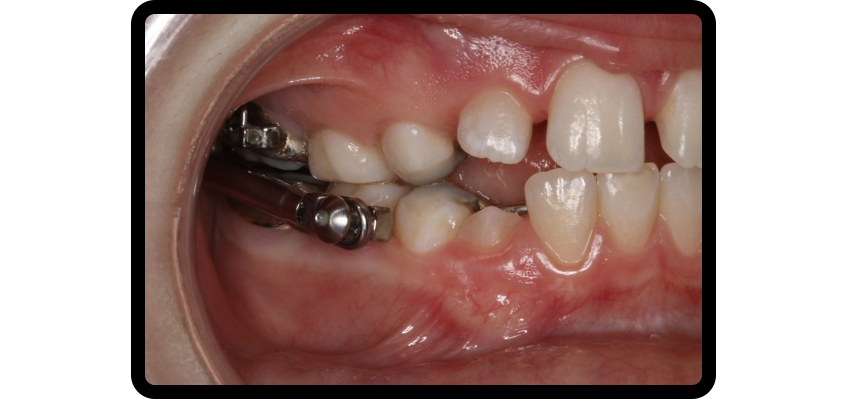 Functional appliance used to influence condyle-disc relationship in a growing patient