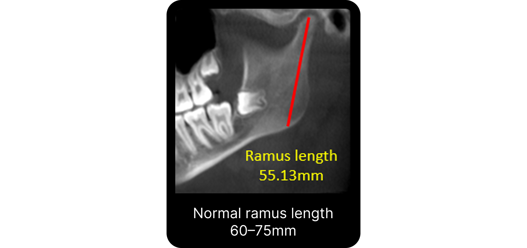 Radiographic measurement of reduced mandibular ramus length linked to TMJ disc displacement