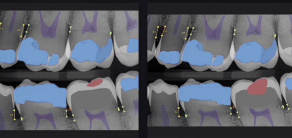 AI in Dental Diagnostics for Stronger Case Acceptance Radiograph analyzed with Overjet’s AI in dental diagnostics color highlighting, showing decay in red and restorations in blue.