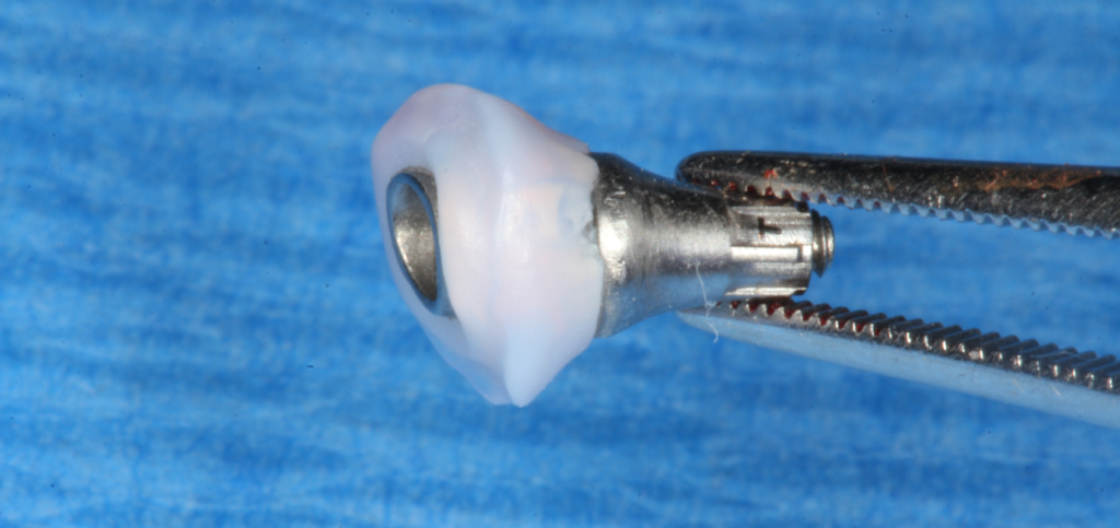 CAD/CAM fabricated custom healing abutment held in a hemostat before placement.