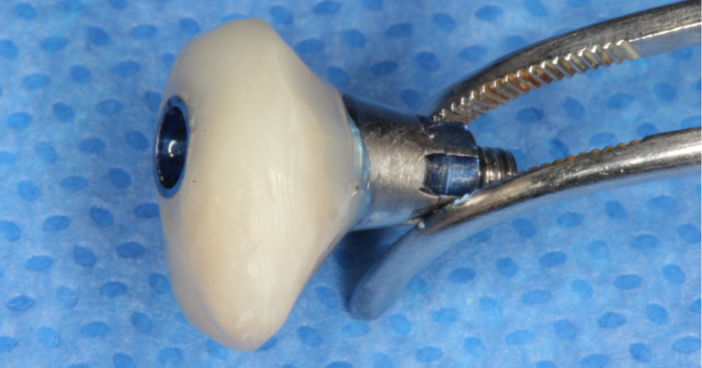 Chairside-fabricated custom healing abutment held with a hemostat.