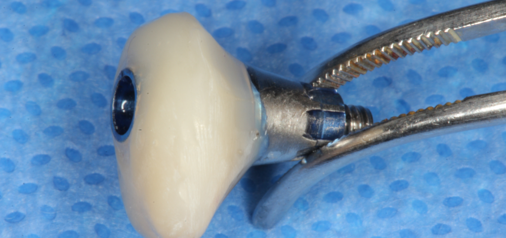 Chairside fabricated custom healing abutment held in a hemostat before placement.