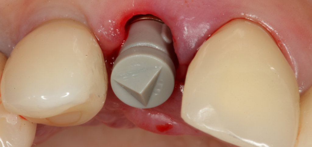 Scan body capturing esthetic zone socket anatomy for a CAD/CAM custom healing abutment.