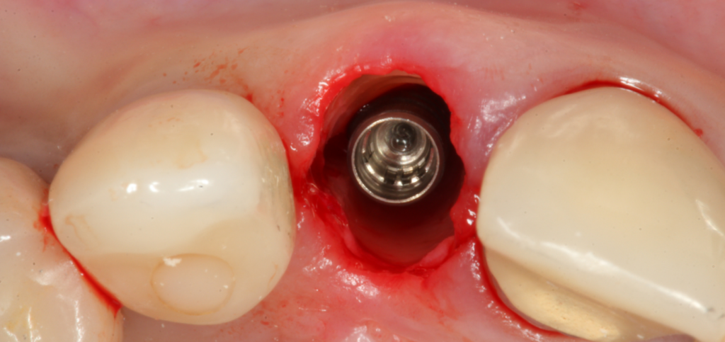 Immediate implant placed in an esthetic zone extraction socket before custom healing abutments are fabricated.