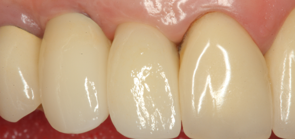 Close-up of a final esthetic zone restoration with an emergence profile shaped by a custom healing abutment.