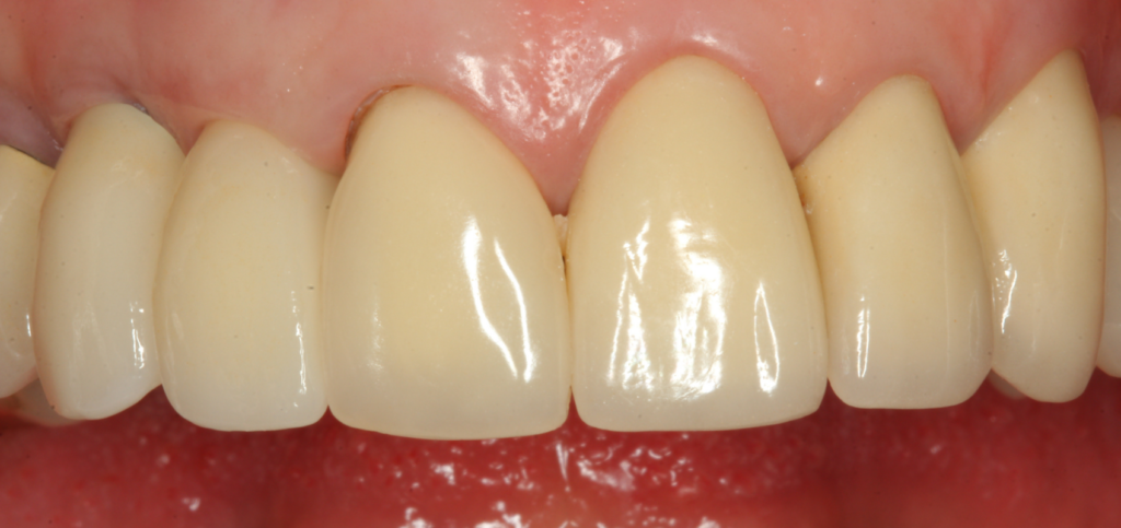 Final esthetic zone restoration with healthy tissue contours shaped by a custom healing abutment.