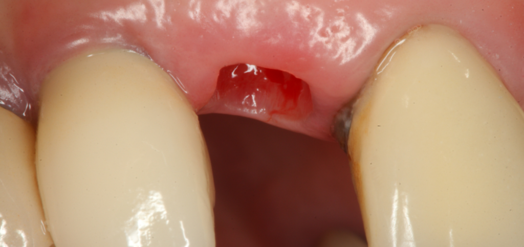 Buccal view of an esthetic zone extraction site after removal of custom healing abutments, showing the maintained tissue contour.