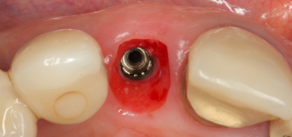 Esthetic zone extraction site after removal of custom healing abutments, showing the maintained tissue contour.
