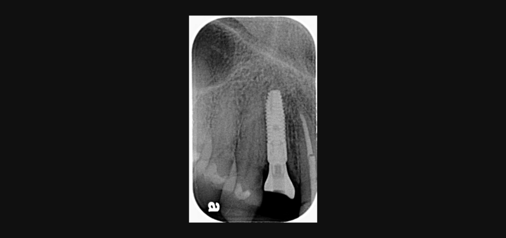 Periapical radiograph showing an implant with custom healing abutments seated in the esthetic zone.