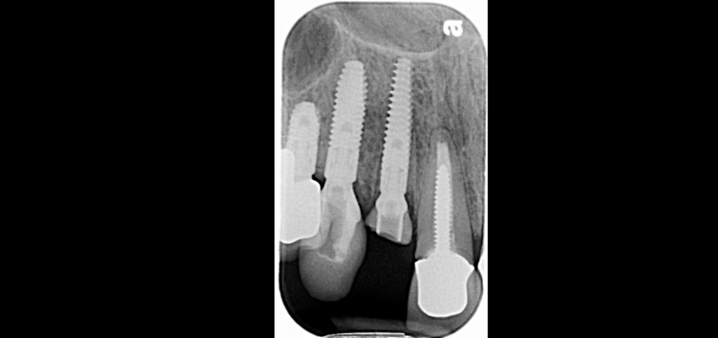 Periapical radiograph showing an immediate implant and CAD/CAM fabricated custom healing abutments in the esthetic zone.