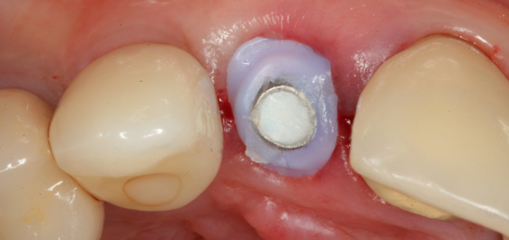 Custom healing abutment in place in an esthetic zone socket.